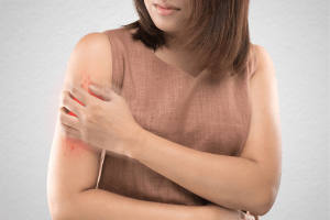 Woman itching mosquito bit to represent malaria treatment