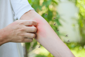 Man itching mosquito bite to emphasise importance of malaria prevention treatment