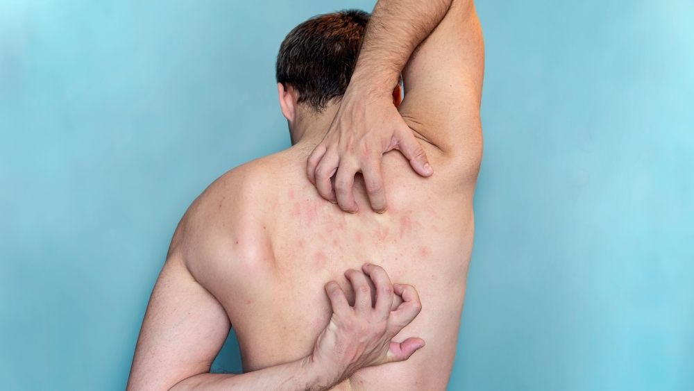 Scabies