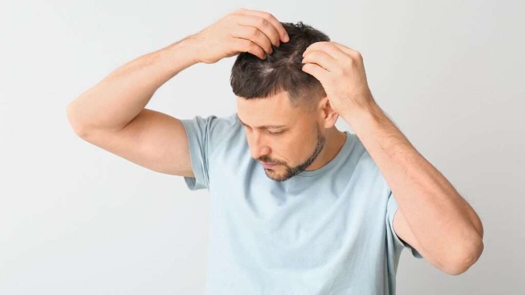 Man showing hair loss to display a need for treatment