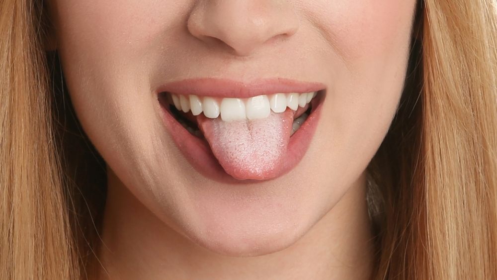 Oral Thrush